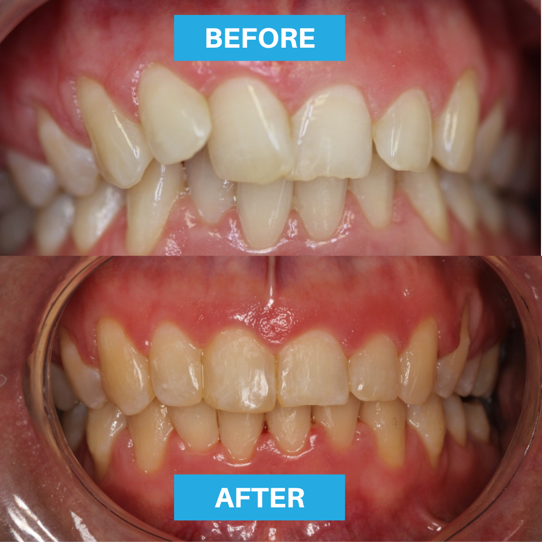 senior master fast braces adelaide dentist