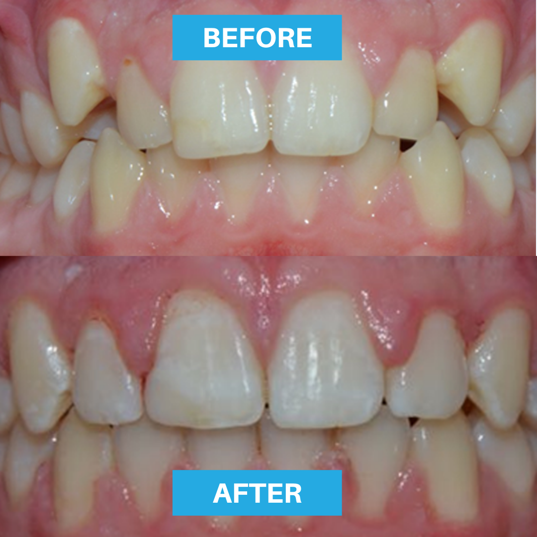 senior master fast braces adelaide dentist